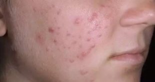 اكثر من تناول هذه الأطعمة لتجنب مشكلات البثور وحب الشباب