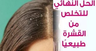 التخلص من قشرة الشعر بوصفات طبيعة في البيت-قشرة الرأس
