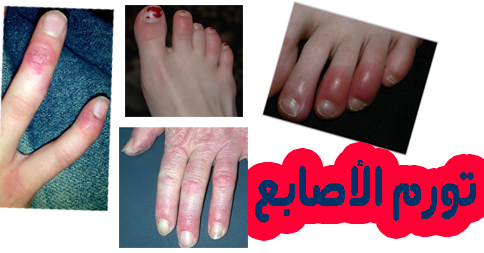 علاج تورم أصابع القدم بوصفات طبيعية