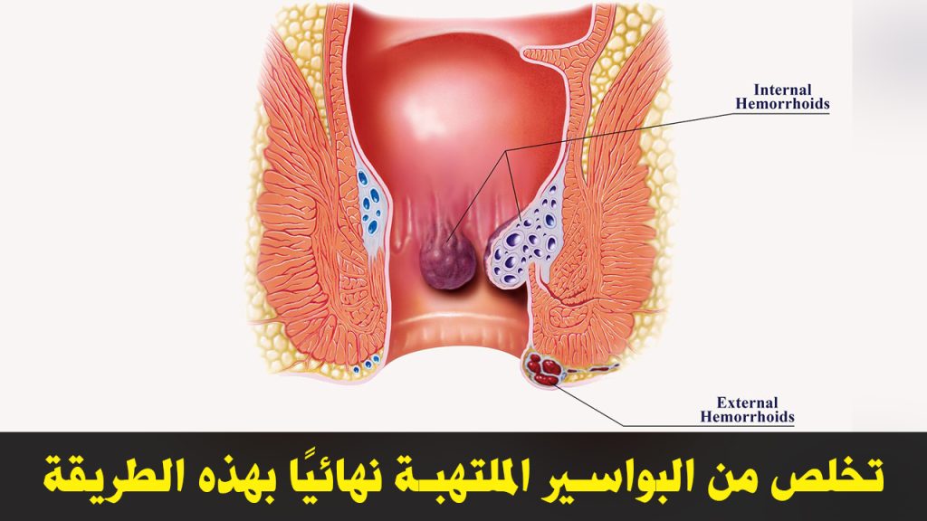 البواسير الملتهبة